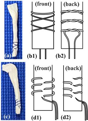 An Efficient Needleless Grasping Suture Technique for Graft Preparation in Anterior Cruciate Ligament Reconstruction